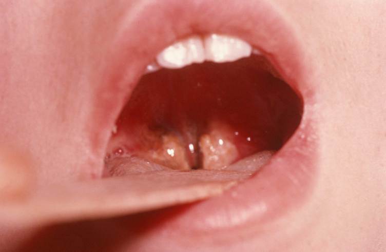 A tongue depressor holds open a person’s mouth so you can see two swollen brownish patches at the entry to the throat.